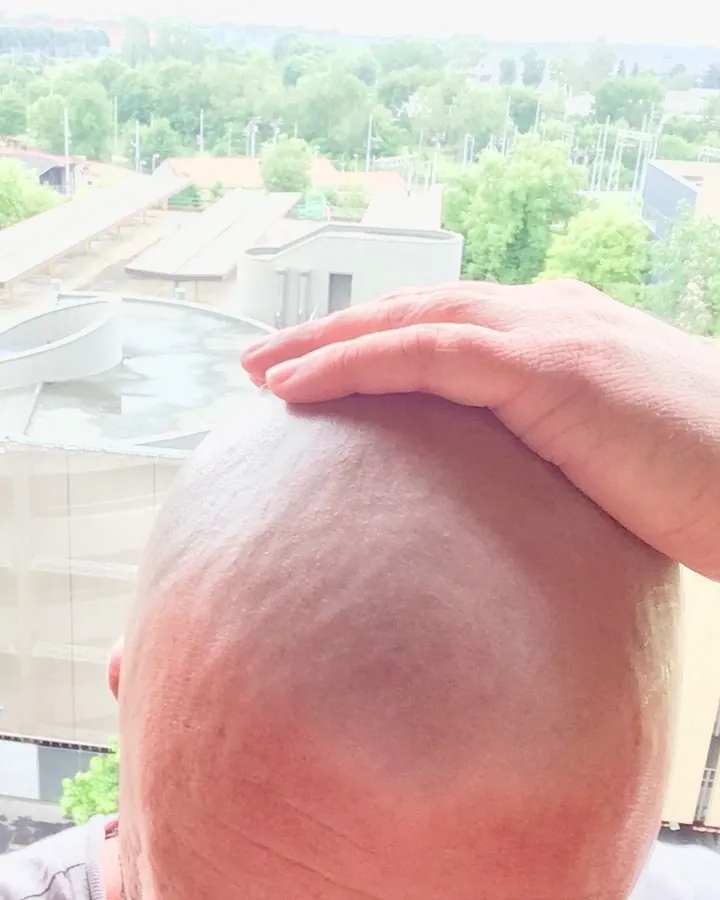 Plan rapproché du crâne rasé d'un homme, main sur la tête, vue depuis l'arrière, paysage urbain flou en arrière-plan.